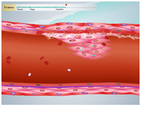 Explore what happens at the cellular level when a vascular injury occurs, and the timeline for treatment and healing.