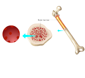 Learn more about myelodysplastic syndromes, which are neoplastic bone marrow disorders associated with abnormal cell growth. Our videos are helpful for oncological distance microlearning.
